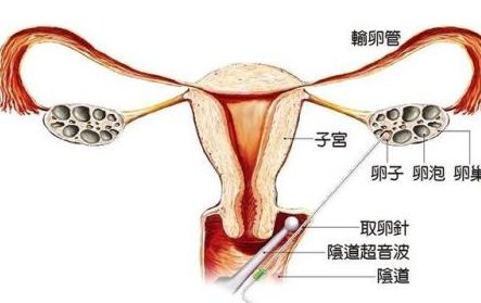女性有染色体罗氏易位在福泉市做试管养囊成功率高吗？试管移植后需要保胎吗！