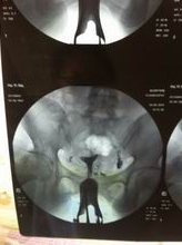 杭州做三代试管婴儿大概要多少钱？费用高不高？